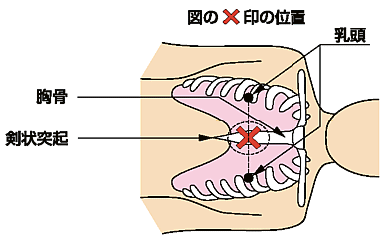 圧迫 胸骨